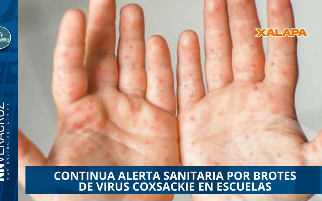 ALERTA SANITARIA EN VERACRUZ POR BROTES DE VIRUS  COXSACKIE EN ESCUELAS 