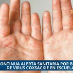 ALERTA SANITARIA EN VERACRUZ POR BROTES DE VIRUS  COXSACKIE EN ESCUELAS