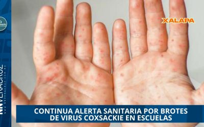 ALERTA SANITARIA EN VERACRUZ POR BROTES DE VIRUS  COXSACKIE EN ESCUELAS
