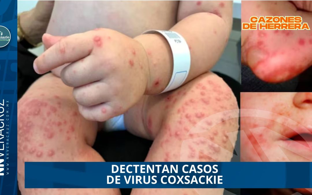 DECTENTAN CASOS DE VIRUS COXSACKIE EN CAZONES DE HERRERA