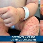 DECTENTAN CASOS DE VIRUS COXSACKIE EN CAZONES DE HERRERA
