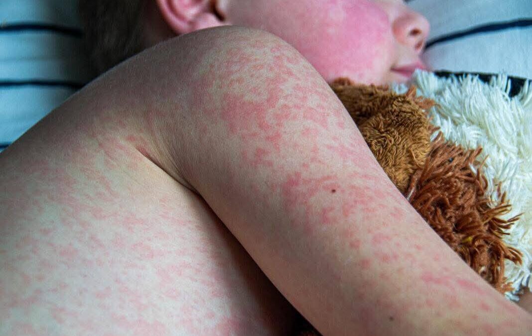 El Sarampión se sale de control…