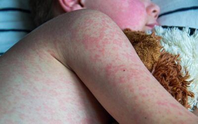 El Sarampión se sale de control…